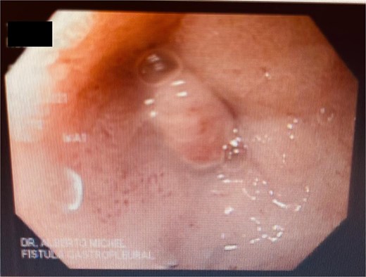 After follow-ups and sponge replacements, the closure of the fistulous defect can be observed.