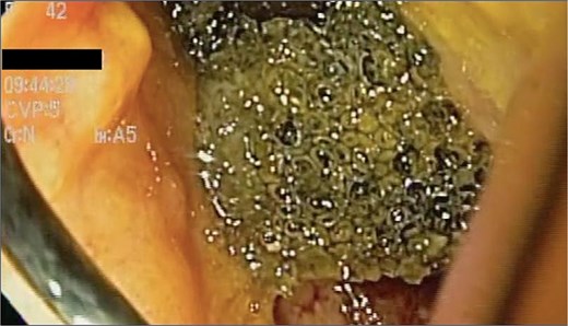 A cavity with an EVAC sponge is seen during endoscopic treatment.