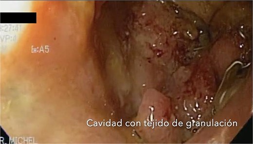 After sponge replacements, granulation tissue is observed in the area where the fistula was located.