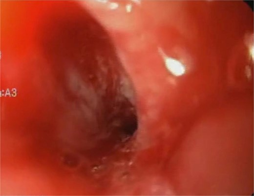 Initial endoscopy shows a fistulous defect below the gastroesophageal junction.