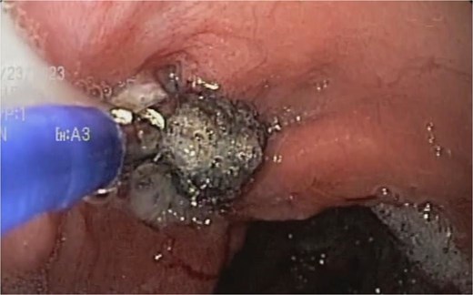 A sponge replacement is performed, revealing a fistulous opening with granulation tissue.