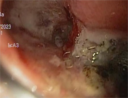 Upon removing the EVAC sponge, we can observe a clean cavernous cavity with minimal fibrin and granulation tissue.