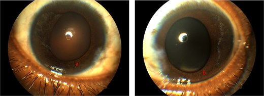 Showing anterior segment photography of right eye (a) and left eye (b) respectively with iris atrophy temporally and torn iris sphincters.