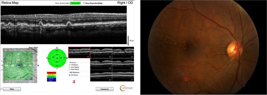 Showing the optical coherence tomography (OCT) scan of the macular with large drusens (a) and fundus photograph of the macular with large drusens at the macular (b) in the right eye.