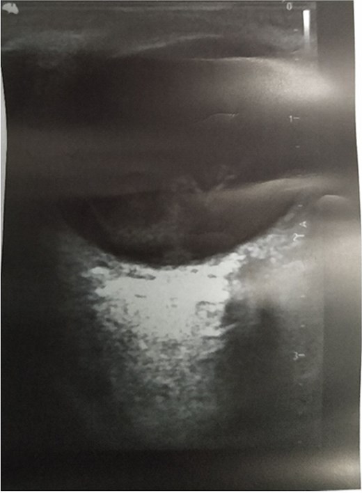 Showing ocular ultrasound of vitreous hemorrhage in the left eye.