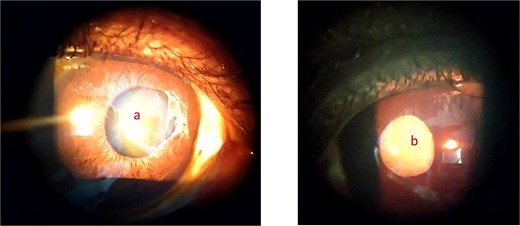 Showing anterior segment photograph of the right eye with iris atrophy (a) and complicated cataract in the left eye (b).