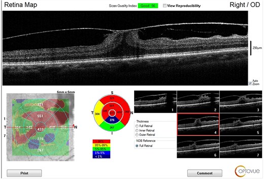 Showing OCT of the right eye with vitreomacular traction.