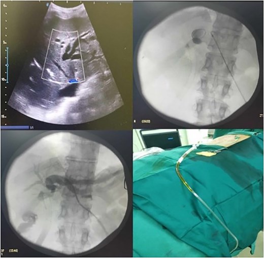Ultrasound exploration and PTBD placement.
