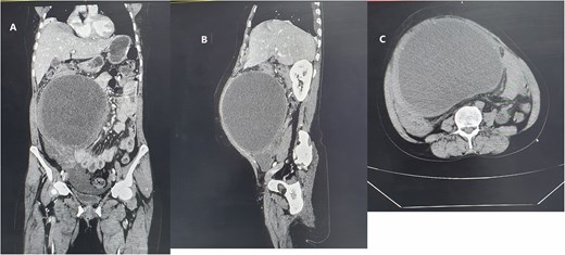 Homogenous hypoattenuating large unilocular cystic mass occupying abdominopelvic cavity with some areas of high attenuating of different viscosity and ovarian vascular pedicle sign as an organ of origin measuring 19.6 × 17.6 × 13 cm (green arrow) (A) coronal enhanced abdominal CT scan (B) enhanced sagittal abdominal CT scan (C) non enhanced upper abdomen axial CT scan.