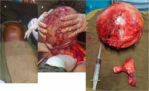 Shows torsion of the right ovarian cystic mass (A) shows the abdominal mass before the surgical excision (B) shows the 360° counterclockwise twist of the right adnexal cyst (green arrow) (C) the resected right adnexal mass along with the uterus.