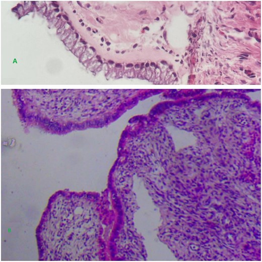 Shows a unilocular cyst with glands lined by a single bland appearing columnar to cuboidal mucinous epithelium.