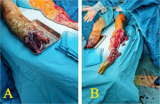 Condition of both calves when arriving at the emergency room (D0) (A) the right calf: Completely severed with tendon retraction and exposure of the proximal tibia and fibula; moderate contamination of the wound; (B) the left calf: Completely severed below the mid-shaft, leaving only 3 cm of skin, accompanied by significant distal tissue destruction characterized by comminuted fractures of the left tibia, calcaneus, and talus.