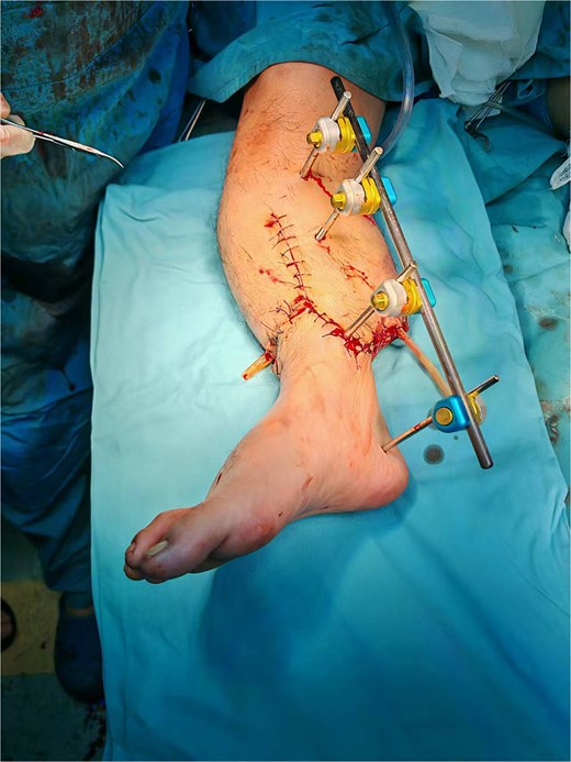The right calf after debridement, shortened artery repair with replantation and external fixation of the tibia (D0).