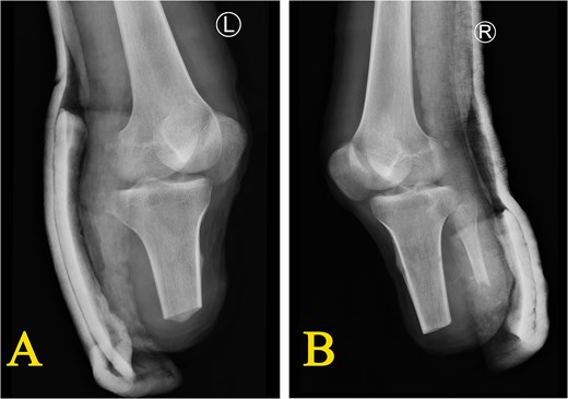 X-ray after bilateral lower limb amputation (D34) (A) post-operative condition of the left calf after local flap transfer repair, showing near complete healing; (B) post-operative condition of the right calf after debridement with vacuum sealing drainage and application of a cast for external fixation.