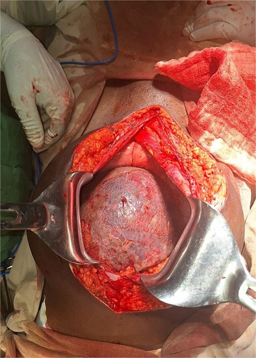 Pelvic spleen with visibly ischemia up on entering to abdomen.