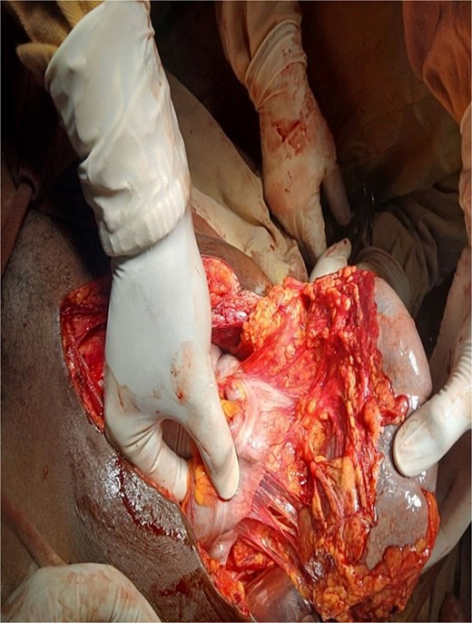 Detorsed spleen with pedicle arising from left gasteroepiploic vessels.