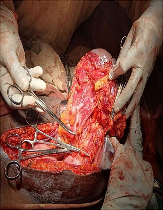 Left gasteroepiploic vessels being ligated.