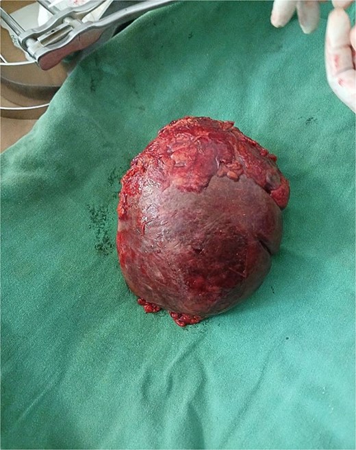 The spleen after removal.