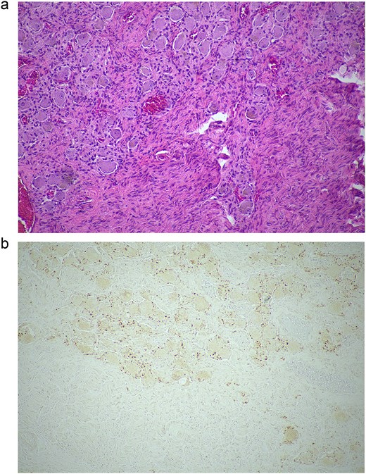 Histopathological examination of the excised lesion—from the first stage partial adrenalectomy—demonstrates characteristic features of a ganglioneuroma. (a) The section shows mature neural tissue with ganglion cells, with all neural tissue lighting with S100 (haematoxylin and eosin staining; 10× magnification). (b) The neoplastic cells are negative for chromogranin (10× magnification).