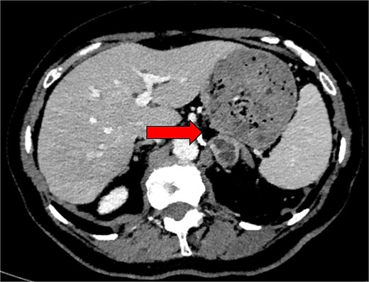 Preoperative axial CT image in 2024 showing an indeterminate left adrenal lesion measuring 28 × 26 × 13 mm, with heterogenous postcontrast enhancement and internal cystic change (indicated by arrow). Absolute and relative washout were calculated at 48.3% and 23.3%, respectively.