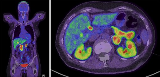 Intense FDOPA uptake is demonstrated in the left adrenal lesion, which is in keeping with a catecholamine-secreting tumour.