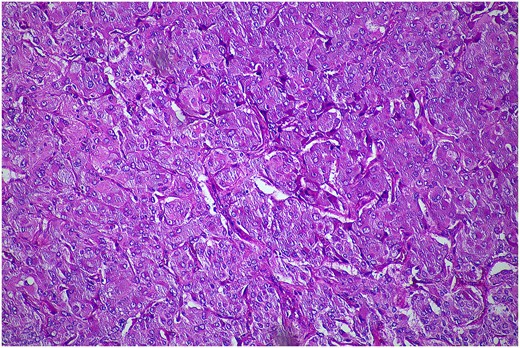 Histopathological examination of the excised lesion—from the second stage completion adrenalectomy—demonstrates characteristic features of a phaeochromocytoma. The section shows atypical polygonal cells with large hyperchrome nuclei, and cytoplasm with a granular appearance S100 (haematoxylin and eosin staining; 10× magnification). The cells are arranged in trabeculae and surrounded with s100 positive supporting cells.