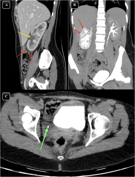 (A) Sagittal section of a contrasted CT scan obtained at the venous phase showing moderate right hydronephrosis (arrow) with perinephric free fluid and fat stranding (arrow). (B) MIP reconstructed coronal images of contrasted CT scans obtained at delayed phases showing delayed renal excretion of the right kidney with minimal contrast extravasation out of the pelvicalyceal system (arrows). (C) Axial section of contrasted CT scan showing distal right ureteric stone about 1.5 cm away from vesicoureteric junction (arrow) surrounded by minimal fat stranding and fluid.