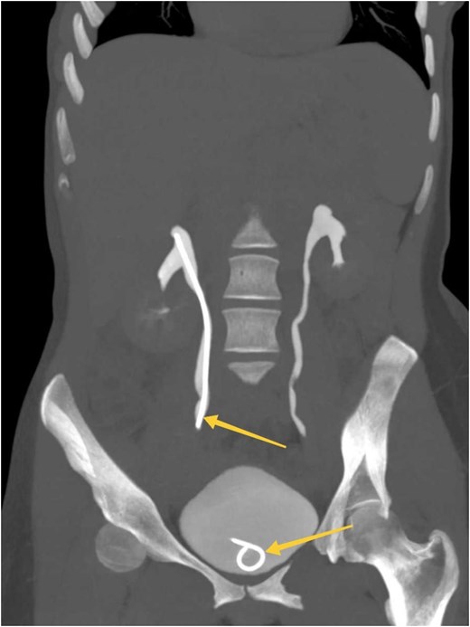 MIP reconstructed coronal images of contrasted CT scan obtained at delayed phases (bone window) showing symmetrical bilateral renal excretion with D-J stent in the right ureter and bladder (arrows).