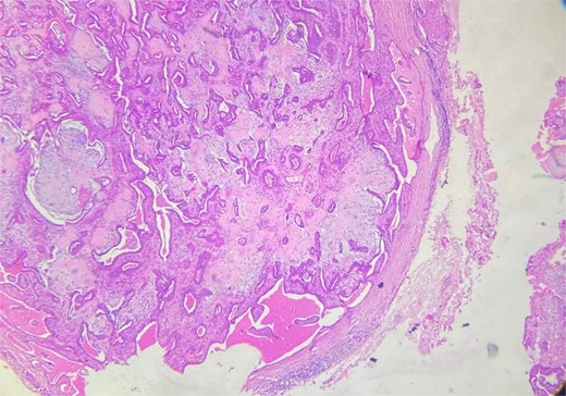 Well-circumscribed benign tumor proliferation.