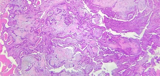Benign tumor proliferation composed of cysts, tubules, and ducts.