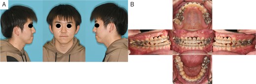 Patient photographs. (A) Extraoral photograph showing symmetrical facial features with a straight lateral profile and mandibular protrusion. (B) Intraoral examination revealed alveolar bone defects in the anterior maxillary teeth region. Temporary anterior teeth were present, with an overbite of +1 mm and an overjet of −7.3 mm. The angle classification of malocclusion was class I.