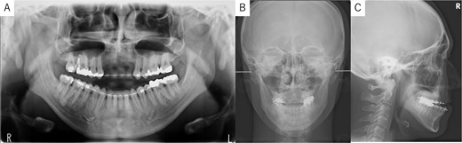 Panoramic radiograph and cephalogram. (A) Panoramic radiograph showing bone loss in the maxillary anterior region from the right to left canine. (B) Frontal cephalogram showing no chin deviation. (C) Lateral cephalogram indicating skeletal mandibular protrusion.