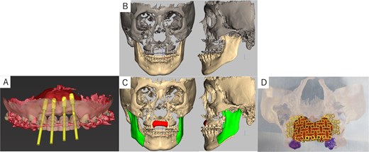 Virtual maxilla reconstruction and SSRO procedures using computed tomography data. (A) Simulation of dental implant placement in the maxillary anterior defect using coDiagnostiX® revealed insufficient bone height and width. (B) Preoperative 3D images. (C) Osteotomy lines and the required bone augmentation were planned. (D) A 3D-printed model was created, and the titanium mesh was shaped to secure space for PCBM grafting.