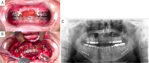 Intraoperative and postoperative images. (A) SSRO surgery was performed with conformity to the orthodontist-prepared final splint. (B) PCBM was grafted into the bone defect and covered with titanium mesh. (C) Postoperative panoramic radiograph showed no abnormalities.