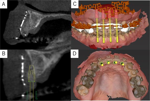 Post-surgery cone-beam computed tomography and implant simulation. (A) Cone-beam computed tomography at 2 months postoperatively confirmed grafted bone stability. (B) Simulation of dental implant placement with a sagittal cross-sectional cone-beam computed tomography image. (C) Frontal view of implant placement. (D) Occlusal view of implant placement.