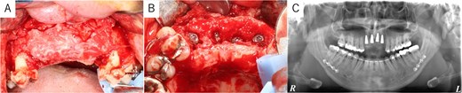 Dental implant placement at 4 months postoperatively. (A) Titanium mesh removal confirmed successful bone augmentation. (B) Dental implants were placed as planned. (C) Postoperative panoramic radiograph confirmed accurate implant placement.