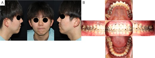 Findings at 1 year postoperatively. (A) Extraoral view showing improvement in skeletal mandibular prognathism. (B) Intraoral view showing the final prosthesis with improved occlusion.