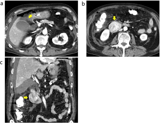 Contrast-enhanced CT before emergency surgery. (a) Free air was observed around the anterior wall in the duodenal bulb, and a perforation in the 1st portion was notes. The arrow indicates free air. (b and c) The tumor in the 2nd portion of duodenum was well enhanced. The arrows indicate the tumor.