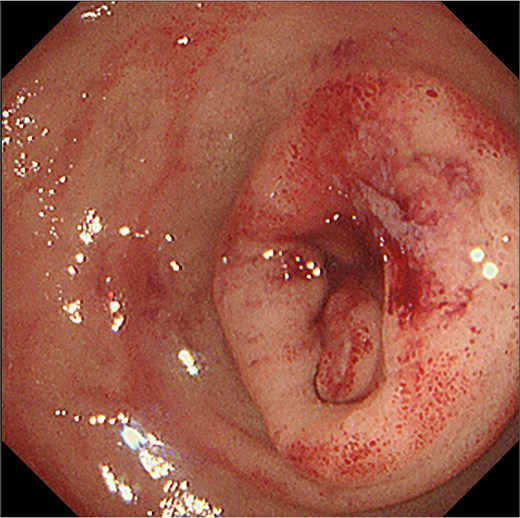Gastro-duodenal endoscopy. Gastro-duodenal endoscopy revealed duodenal stenosis with the duodenal tumor in the 2nd portion. The tumor was biopsied, with subsequent analysis revealing adenocarcinoma.