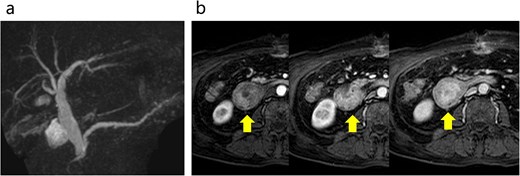 Abdominal MRI. (a) No stenosis was observed in the bile or pancreatic ducts. (b) Contrast enhanced MRI revealed early dark staining in the duodenal tumor. The arrows indicate the tumor.