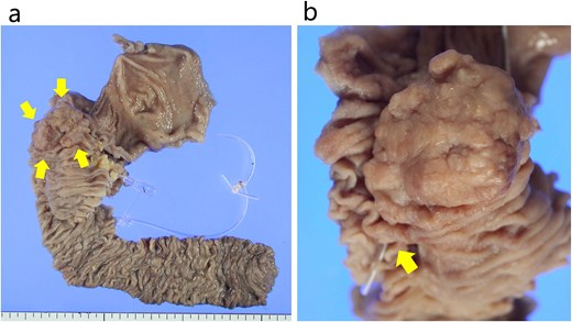 The resected specimen. (a) The specimen comprised a 45 × 35 mm sized protruded and circumferential tumor resected from the 2nd duodenal portion. The arrows indicate the tumor. (b) The papilla Vater was not involved in the tumor. The arrow indicates the papilla Vater.