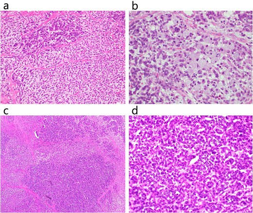 Histopathological examination. Histopathological examination revealed that the tumor had both adenocarcinoma and neuroendocrine components. (a) HE staining of a poorly differentiated adenocarcinoma region (×200). (b) HE staining of poorly differentiated adenocarcinoma and signet ring cell carcinoma (×400). (c) HE staining of NEC (×100). (d) HE staining of NEC (×400).