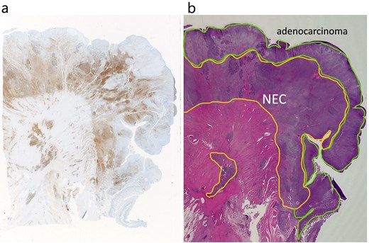 Adenocarcinoma and NEC components in the tumor. (a) Immunochemical staining of chromogranin a was positive in the NEC component (×20). (b) Adenocarcinoma and NEC components accounted for 60% was 40% of the tumor, respectively. Therefore, the tumor was diagnosed MiNEN (×20).