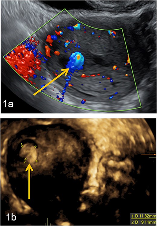 Intra-uterine vascularized mass (arrows) diagnosed by Doppler (a) and 3D-pelvic (b) ultrasound. The Doppler color score is 4 and there is no suspicion of myometrial invasion (continuous halo surrounding the lesion).