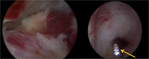 A trophoblastic resection by hysteroscopic tissue removal system TruClear° was performed with the soft tissue shaver (arrow).
