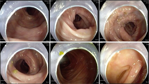 Colonoscopy showed no abnormal lesions in the bowel after admission.