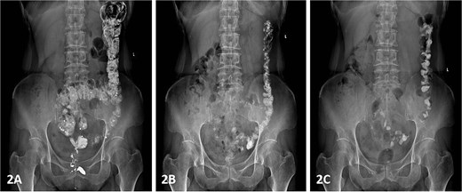 Colonic transit study using radiopaque markers.
