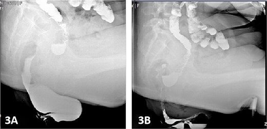 Defecography findings.