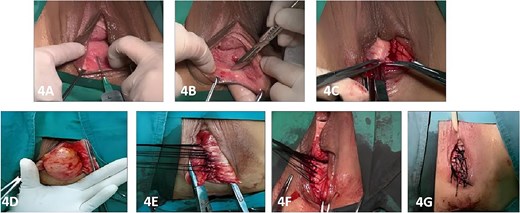 Surgical procedure.