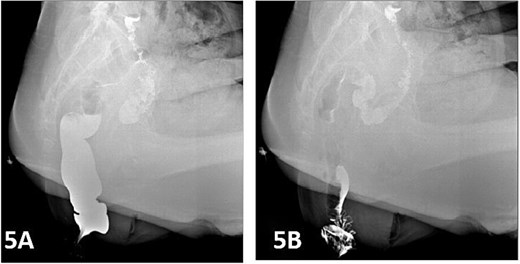 Postoperative defecography at 15 days, the image demonstrates a residual RC depth of 11 mm.